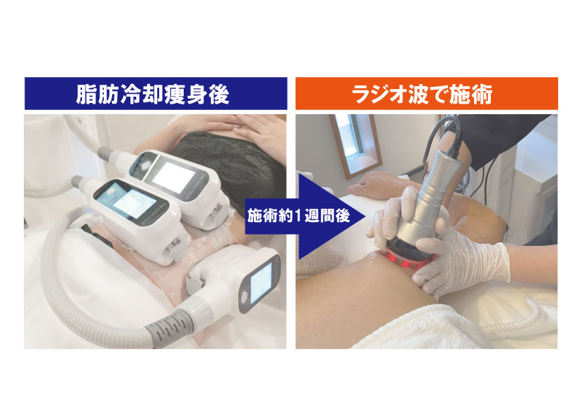 脂肪冷却後にラジオ波をあてる