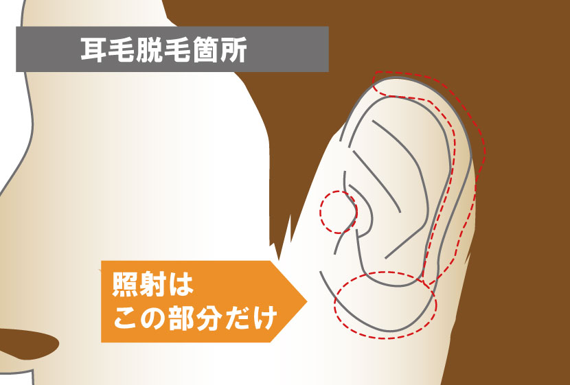 耳毛脱毛可能箇所