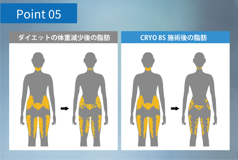 脂肪冷却はリバウンドしにくい