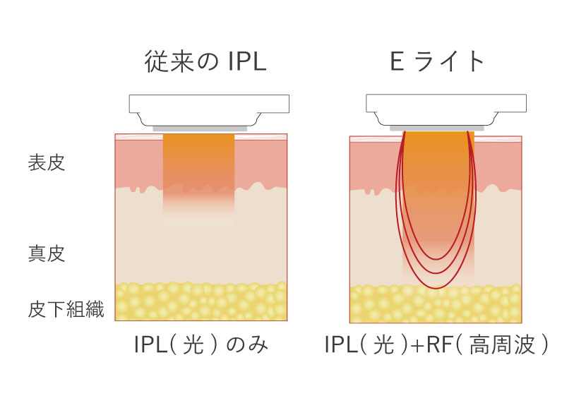 Eライトの仕組み